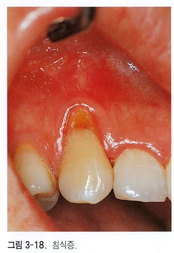 치아 부식 -2
