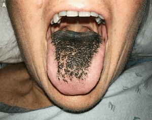 혀 건강상태 - 설모증