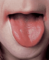 혀 건강상태 - 빈혈