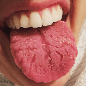 혀 건강상태 - fissured