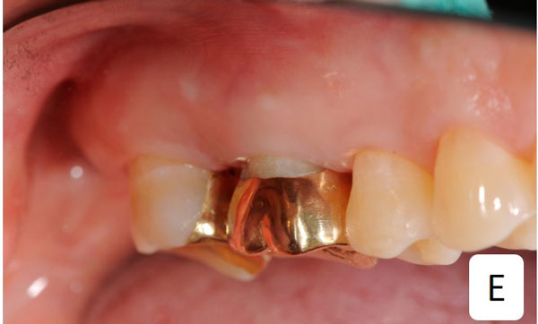 치아 이식 - 4